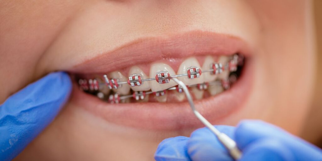 Hidden Braces Behind Teeth  The Orthospaceship- Hakim Orthodontics