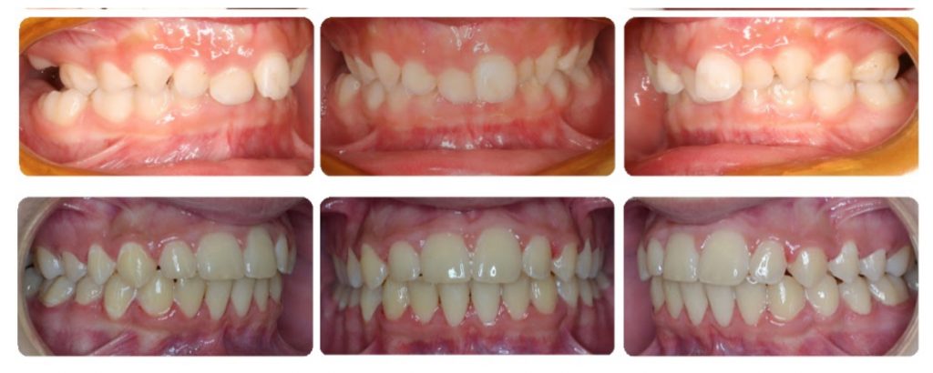 Orthodontic before and after photo of a patient from Los Angeles with a deep bite
