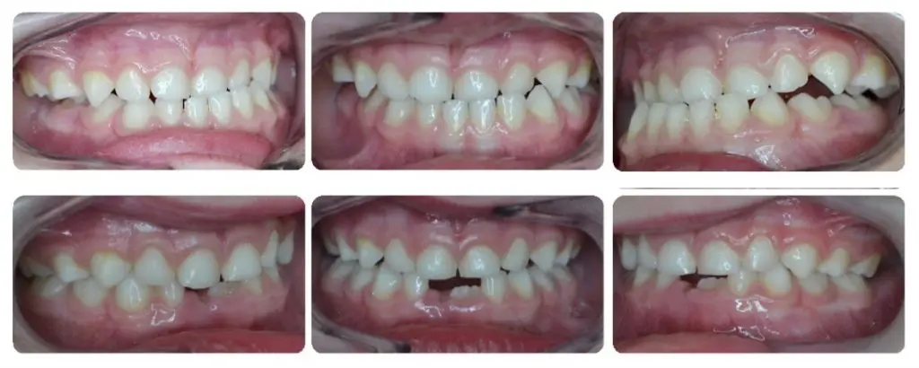 Before and after photo of a pediatric patient of Dr. Hakim, the best orthodontist in Los Angeles.