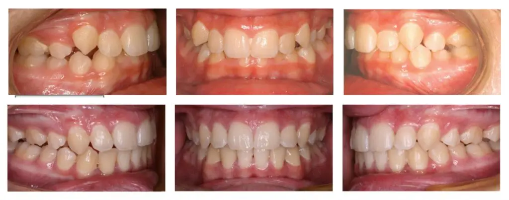 An orthodontic patient of Dr. Hakim who straightened their teeth with braces at our Los Angeles location