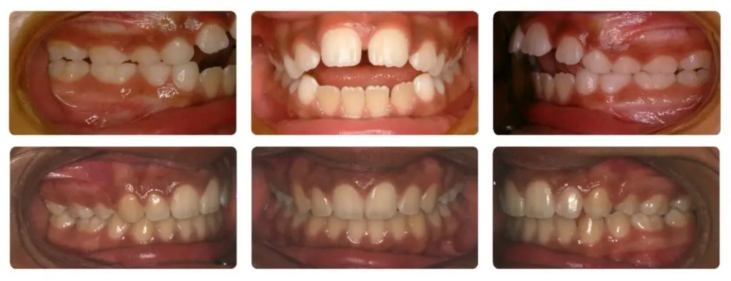 Los Angeles teenager with an open bite who fixed their teeth with braces and elastics at the Orthospaceship 
