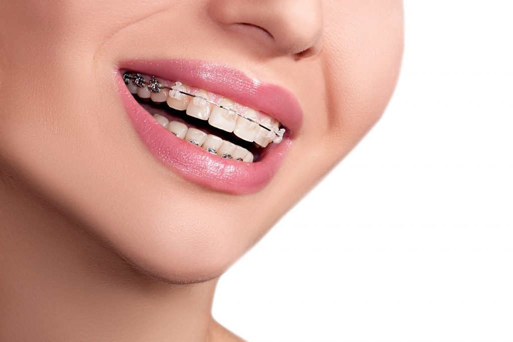 Braces have come a long way, and we have a wide variety of treatment options.