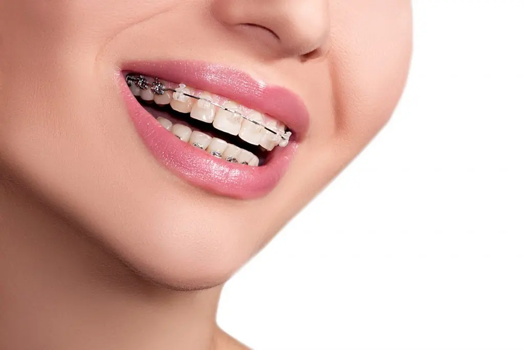 Los Angeles woman smiling with clear braces on her front teeth and traditional metal braces on her back teeth