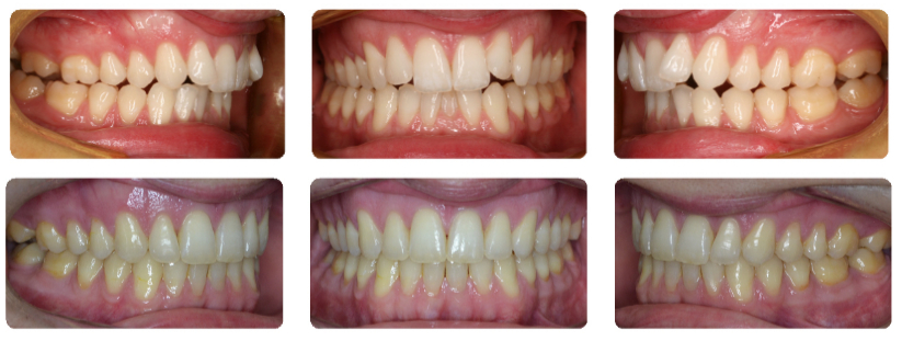 Invisalign before and after photo of a patient in Los Angeles who had crowded teeth