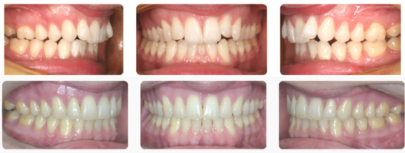 Dr. Hakim's orthodontic patient who had jaw surgery to correct their class II div II malocclusion