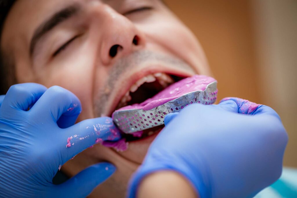 orthodontic assistant in blue gloves taking a messy impression of a man's teeth at the orthodontist office in Los Angeles