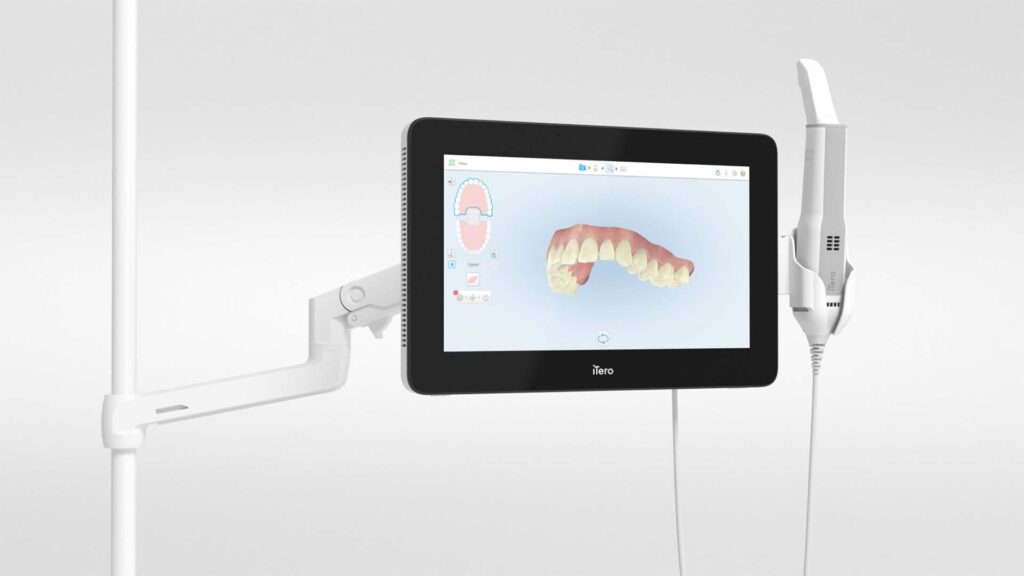 iTero scanner with large display showing scan of a Los Angeles orthodontic patient's upper teeth to make custom clear aligners to straighten teeth