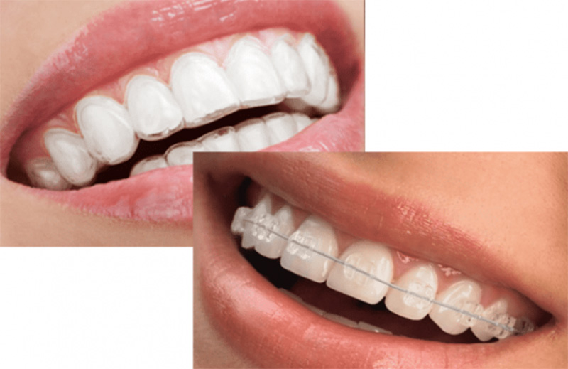 Orthodontic Treatments like clear aligners similar to Invisalign and clear, ceramic braces