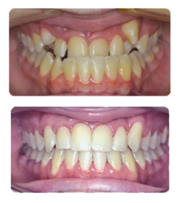 Before and after orthodontic results showing how our extremely nice orthodontist offers Southern California and the Los Angeles area dental services such as teeth straightening and teeth whitening.