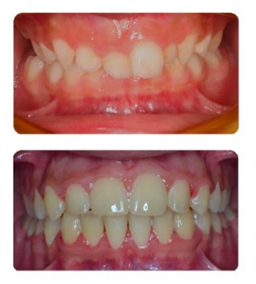 Before and after orthodontic picture showing how our orthodontists in Los Angeles fixed the patient's teeth for a perfect smile.
