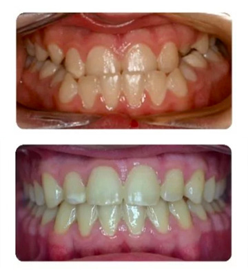 Before and after results of new patients showing how the best orthodontist for Bel Air, Los Angeles straightened the teeth and fixed the bite.