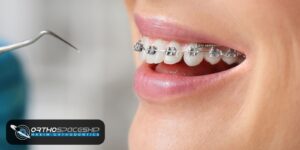 What should I do if my braces hurt?