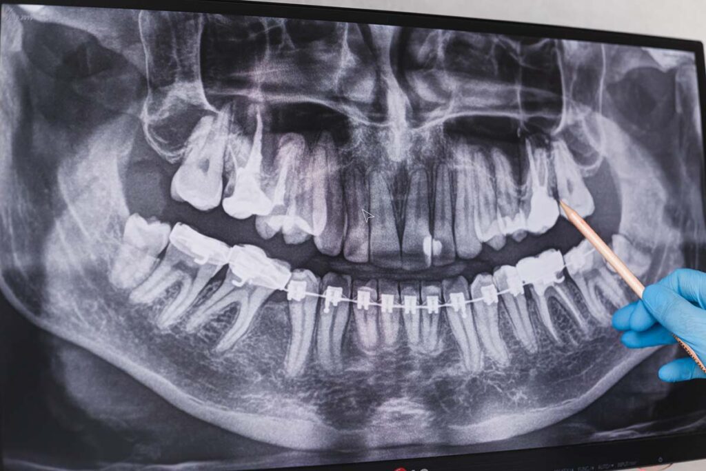 Orthodontic xray of patient with ceramic braces on bottom teeth