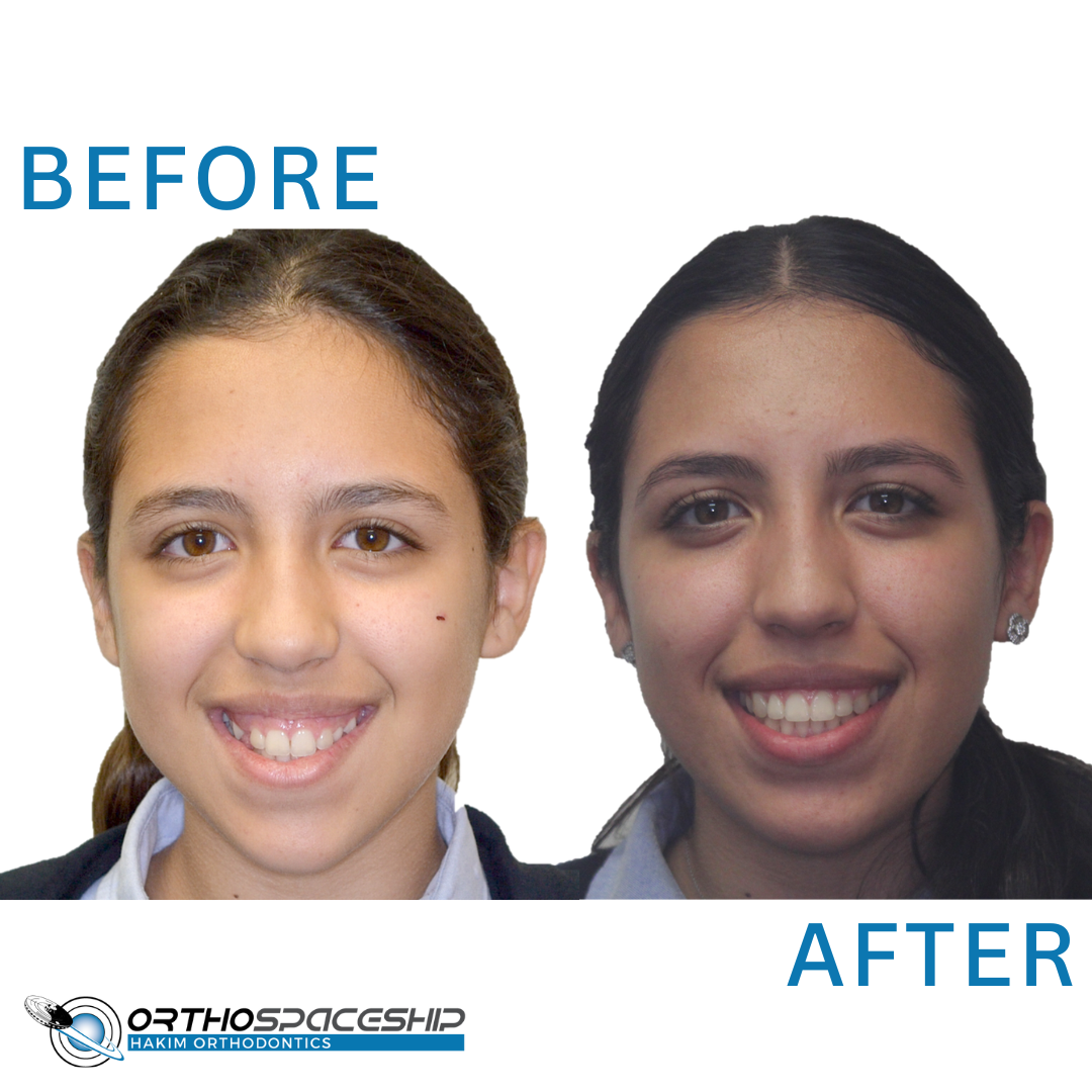 patient with excessive gingival display treated by Dr Hakim, the best orthodontist for gummy smiles