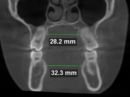 15 yr-old girl still has skeletal discrepancy following ALF treatment