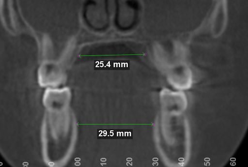 12 year-old boy has no true skeletal expansion following ALF treatment