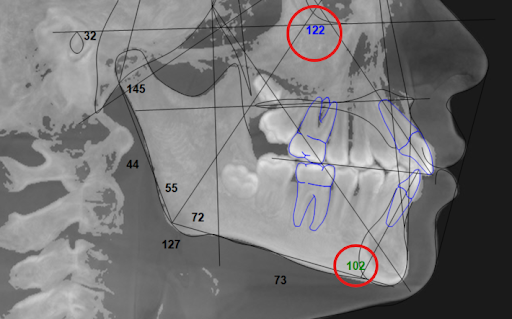 12 year-old boy's flared front teeth following ALF treatment