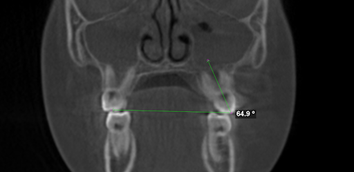 12 year-old boy's severely tipped out teeth following ALF Treatment