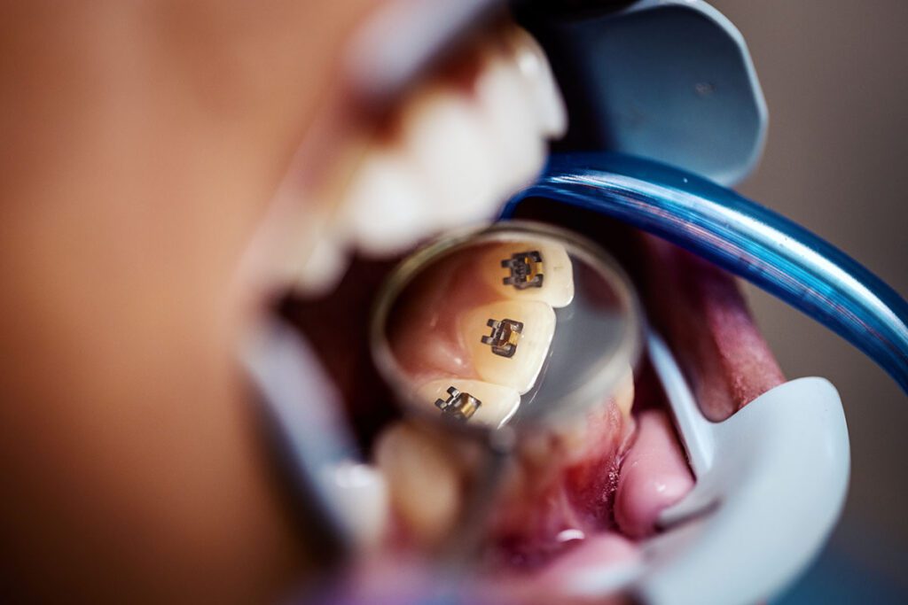 At The OrthoSpaceship, we’ve intentionally chosen to use a self-ligating lingual bracket system