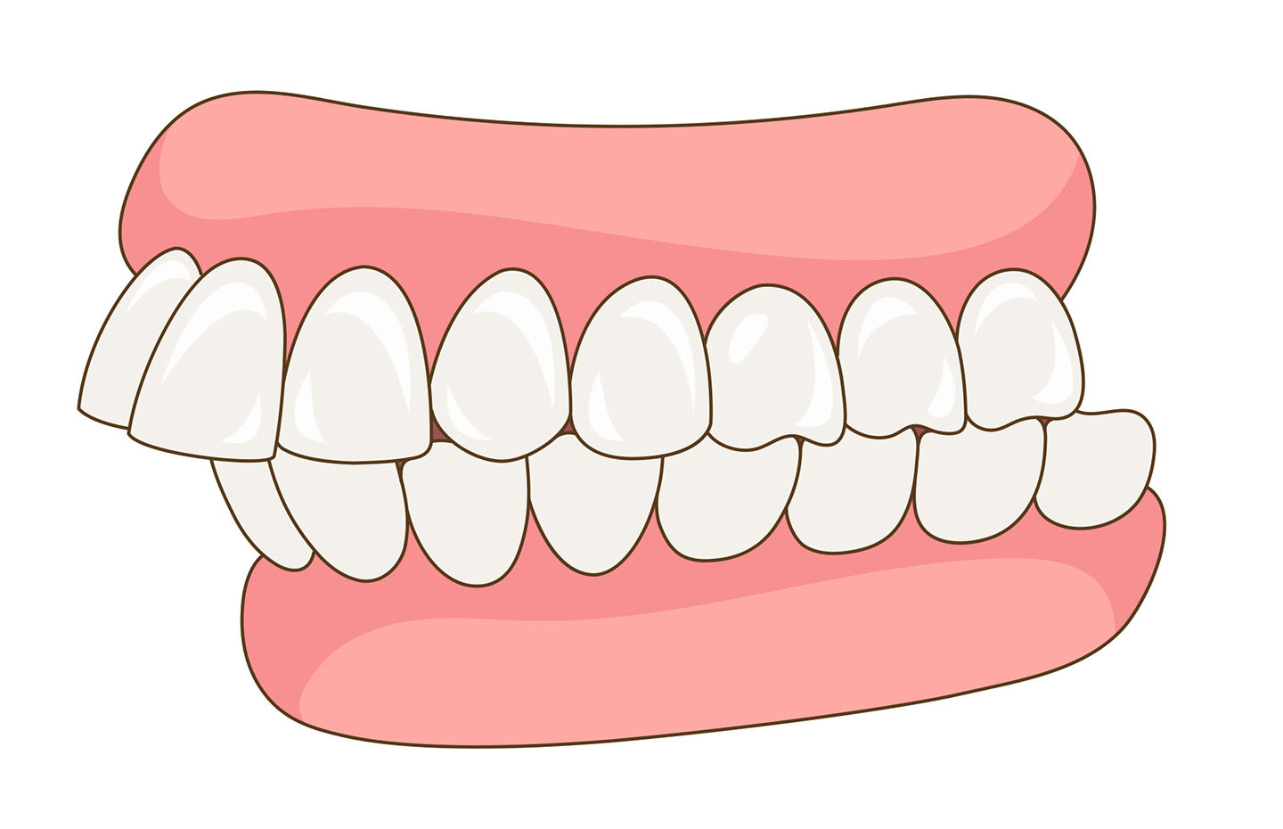 Overbite malocclusion illustration