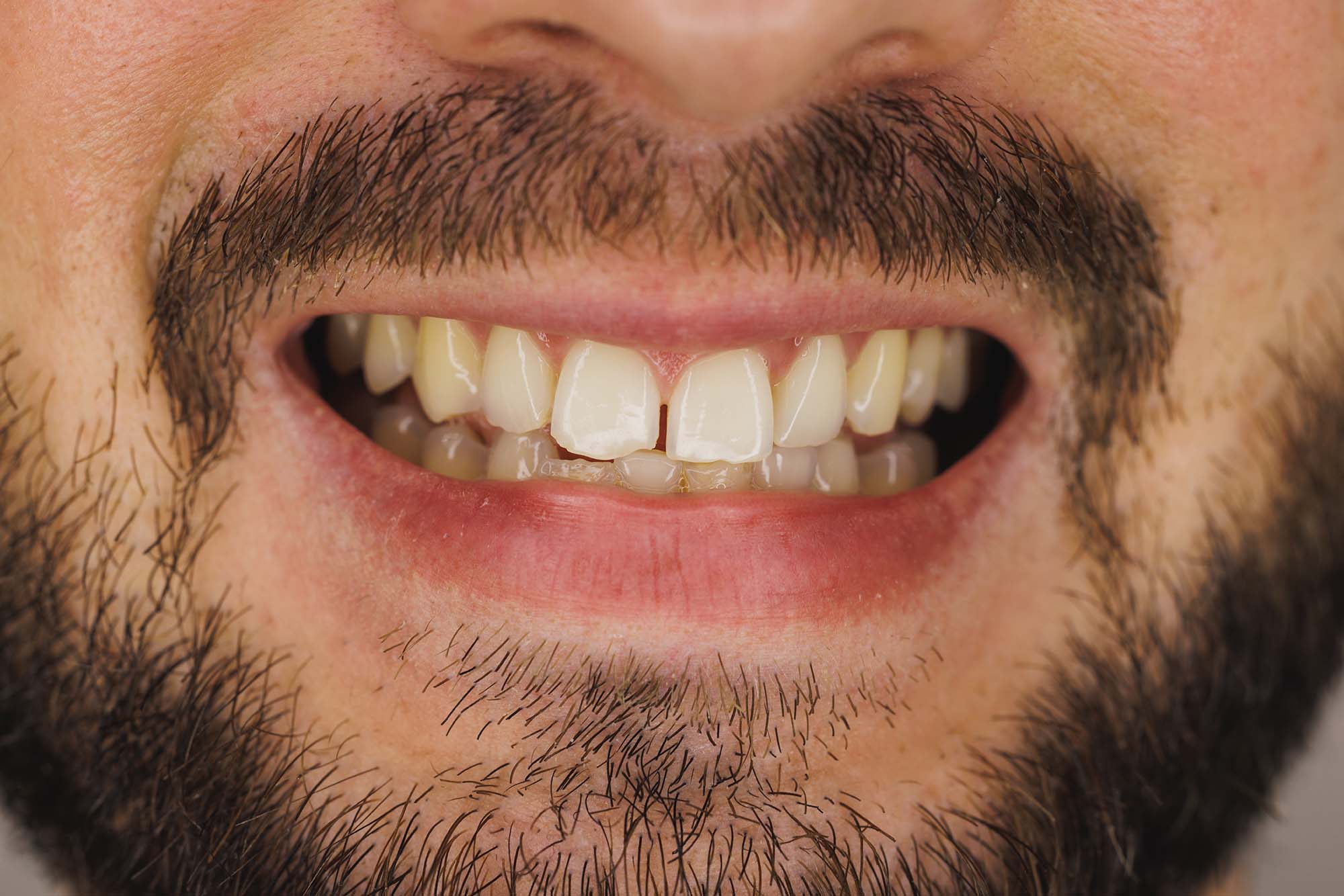 close up of a man's gapped teeth