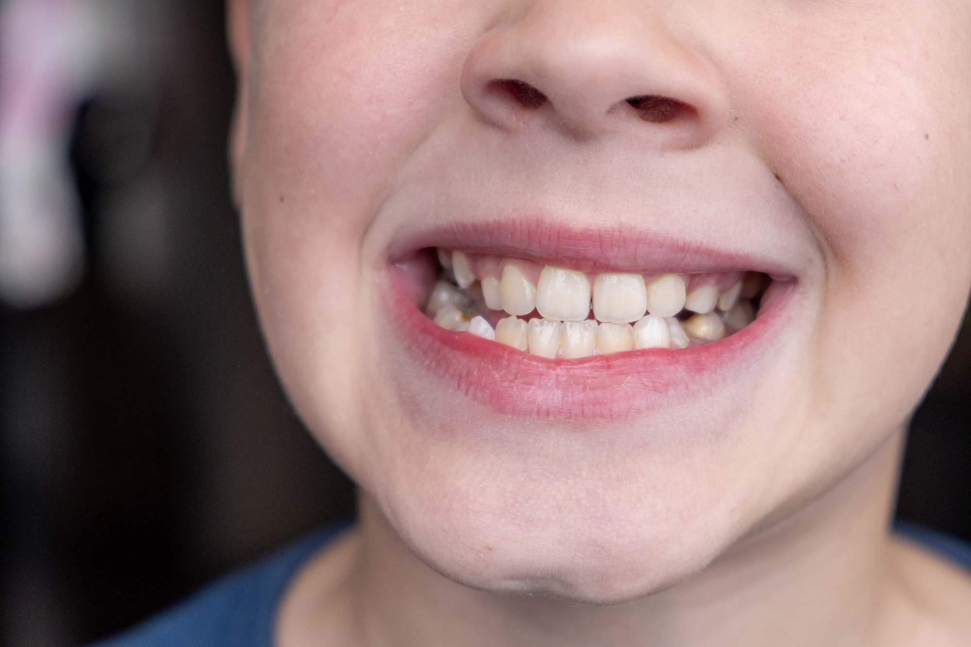close up photo of a smiling child with a crossbite