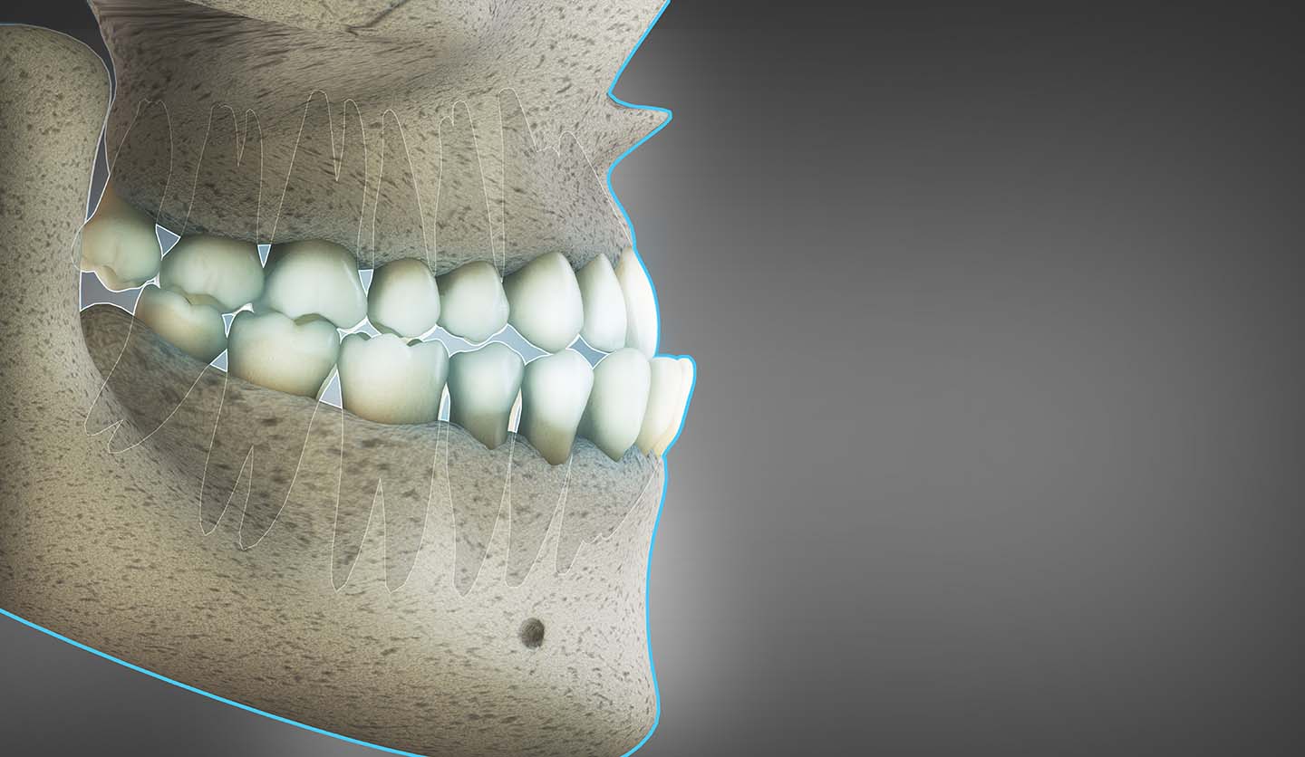 Illustration of the skeletal jaw and teeth in a person with an underbite
