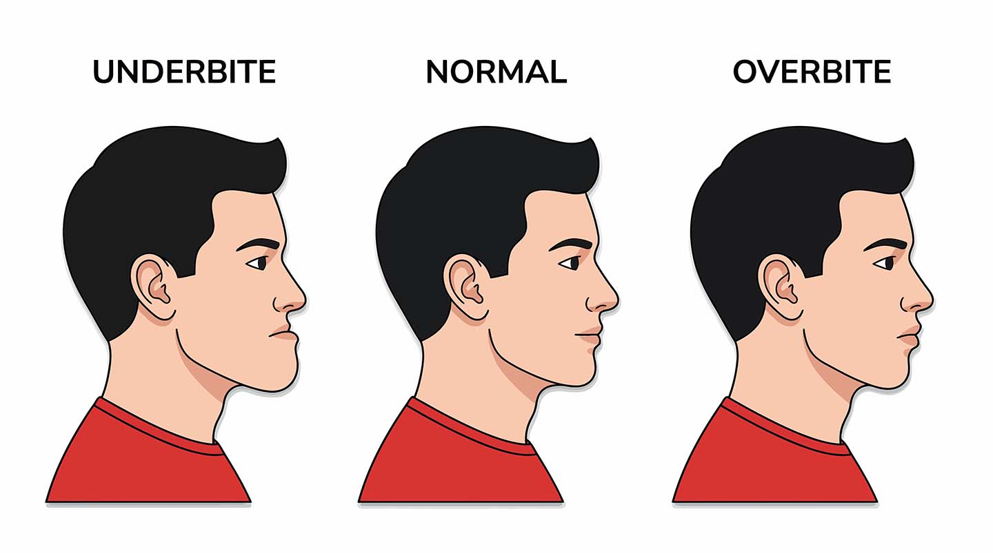 Illustration showing an overbite, a normal bite, and an underbite